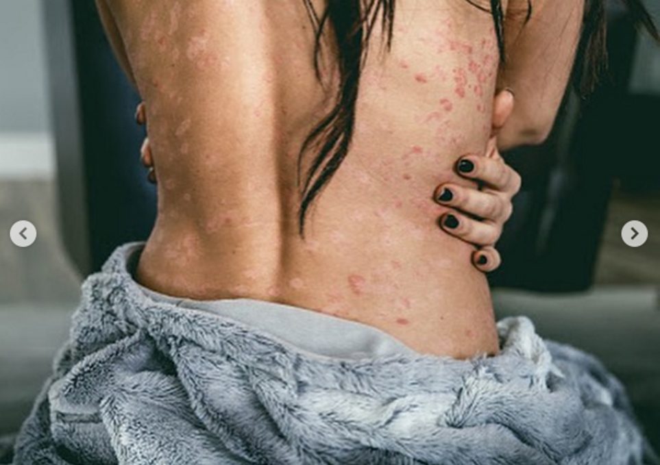 Tenille Dashwood Reveals Psoriasis Scars