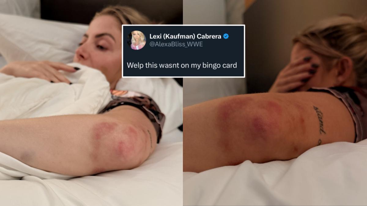 Alexa Bliss' photos of her bruised elbow after the July 10, 2026 WWE SmackDown episode